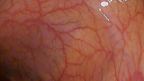 A colonoscopy view of the colon. Photo: via Wikimedia Commons (CC licence, see Commons file page).