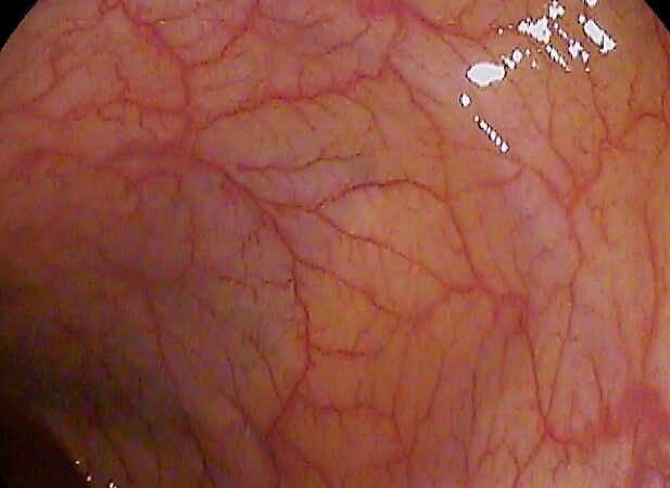 A colonoscopy view of the colon. Photo: via Wikimedia Commons (CC licence, see Commons file page).
