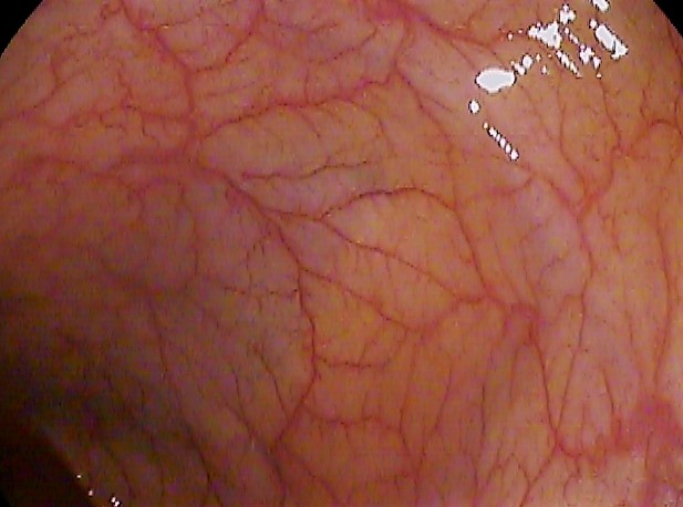 A colonoscopy view of the colon. Photo: via Wikimedia Commons (CC licence, see Commons file page).