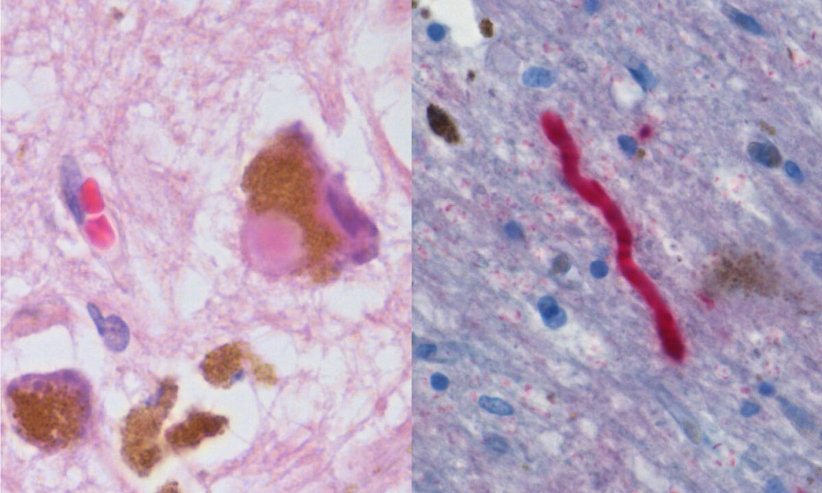 Substantia nigra tissue in Parkinson's disease. Photo: Filip em, via Wikimedia Commons (CC licence, see Commons file page).