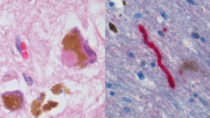 Substantia nigra tissue in Parkinson's disease. Photo: Filip em, via Wikimedia Commons (CC licence, see Commons file page).