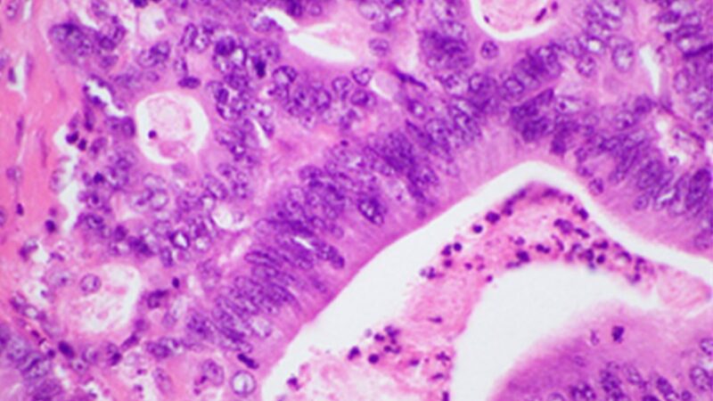Histopathology of pancreatic ductal adenocarcinoma. Image: Singh et al., PLOS ONE, CC BY 4.0, via Wikimedia Commons.