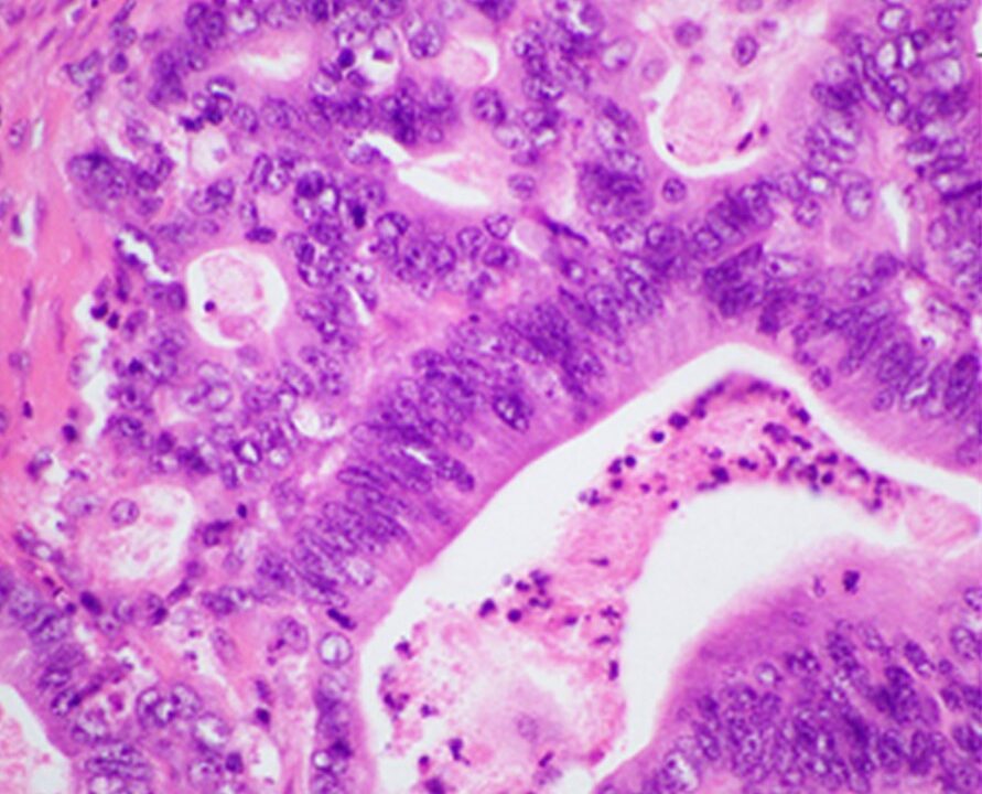 Histopathology of pancreatic ductal adenocarcinoma. Image: Singh et al., PLOS ONE, CC BY 4.0, via Wikimedia Commons.